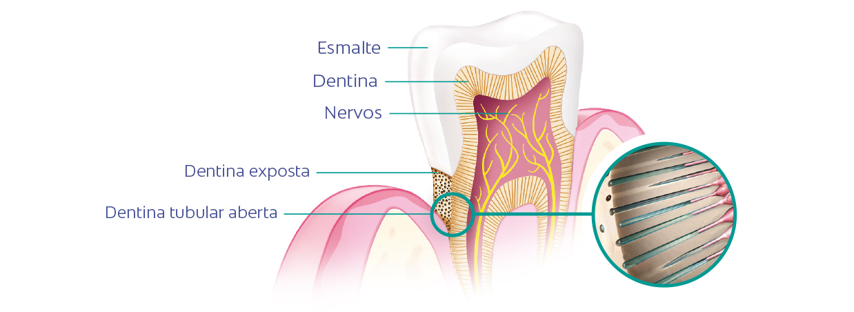 Ilustração de um dente em corte com rótulos: esmalte, dentina e nervos; mostra dentina exposta e túbulos dentinários abertos em detalhe ampliado.