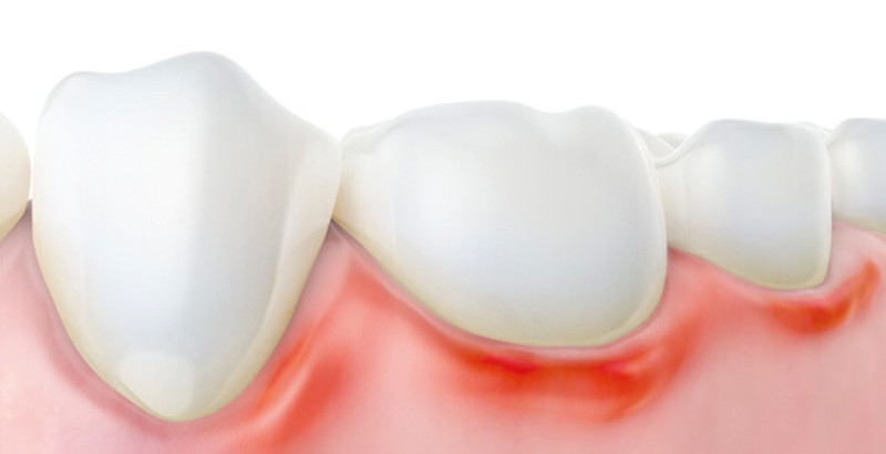 Ilustração de gengiva avermelhada e inchada ao redor dos dentes