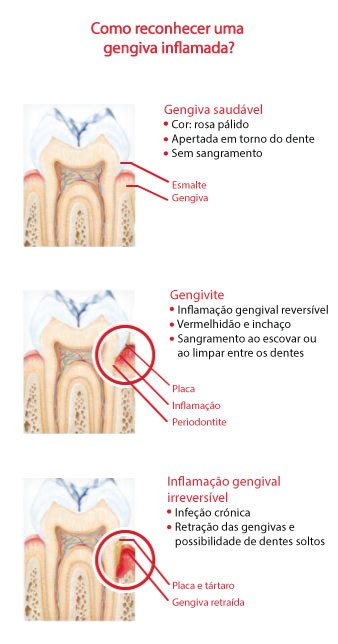 Infográfico com três etapas da saúde gengival: saudável, gengivite e inflamação gengival irreversível.